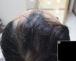 -大麦微针植发丨全国连锁