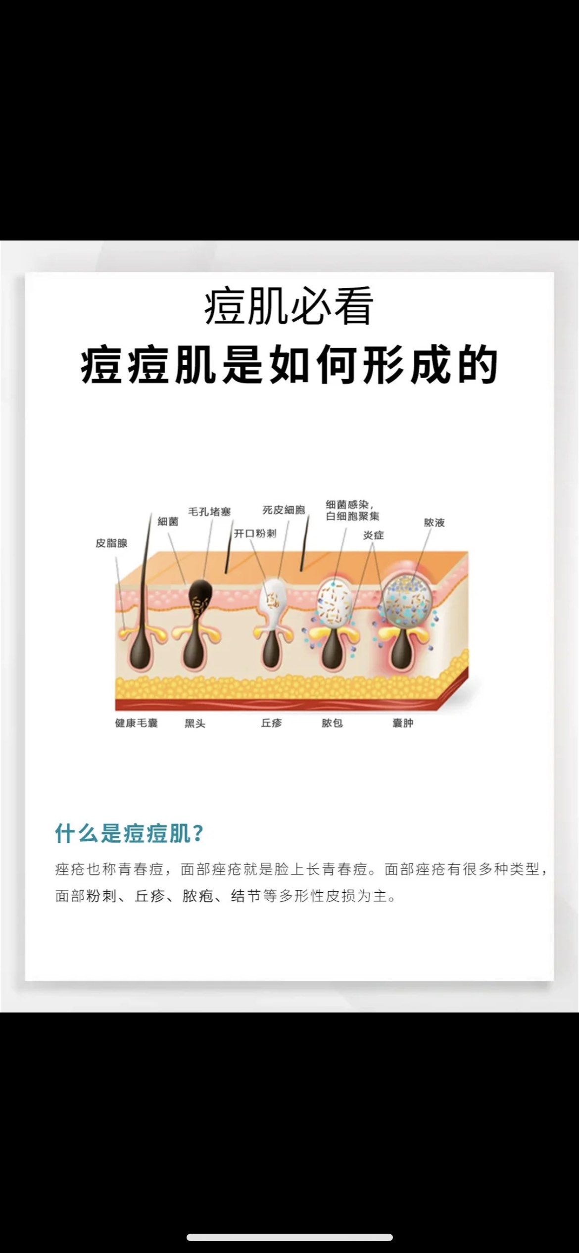 所有痘痘的名称及图片图片