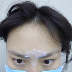 体验前-More摩尔医美の注射线雕光电中心