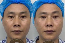 体验前-广州健丽·去眼袋医疗美容机构