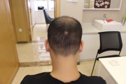 -大麦微针植发丨全国连锁