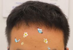 -大麦微针植发全国连锁