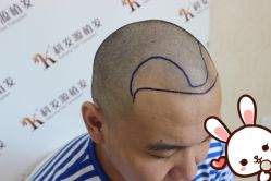 点击看大图 -大麦微针植发丨全国连锁