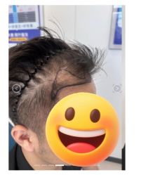 -大麦微针植发全国连锁