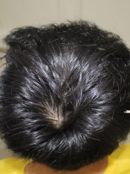 -大麦微针植发丨全国连锁