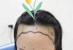 点击看大图 -大麦微针植发全国连锁