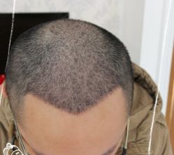 -大麦微针植发丨全国连锁