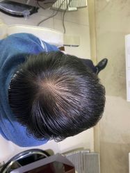 -大麦微针植发全国连锁