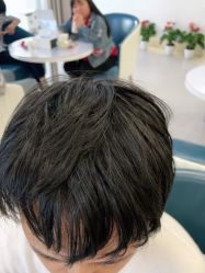 -大麦微针植发全国连锁