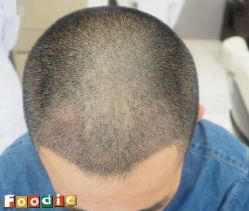 -大麦微针植发丨全国连锁