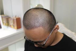 -大麦微针植发丨全国连锁