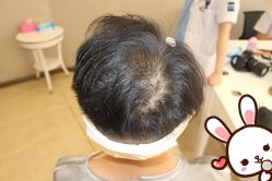 -大麦微针植发丨全国连锁