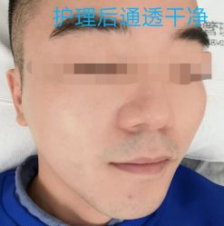 -倩极·精研痘敏肌管理