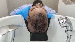 -大麦微针植发全国连锁