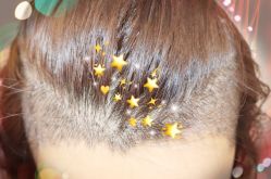 -大麦微针植发全国连锁