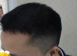 -大麦微针植发丨全国连锁