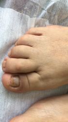 -德哥灰指甲脚气甲沟炎跖疣护理