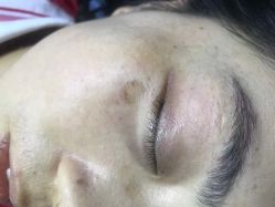 -爱莎扁平疣·汗管瘤·斑痣中心
