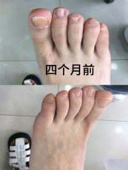 -德哥灰指甲脚气甲沟炎跖疣护理