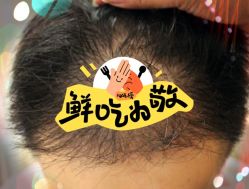 -大麦微针植发全国连锁