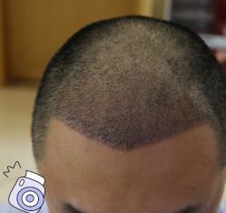 -大麦微针植发丨全国连锁