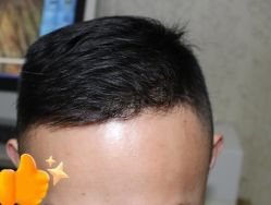 -大麦微针植发丨全国连锁