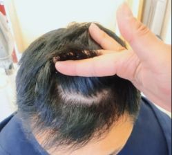 -大麦微针植发全国连锁