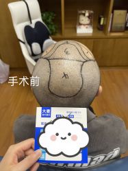 -大麦微针植发全国连锁