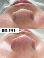 -塑青春&伊肤泉祛痘皮肤管理