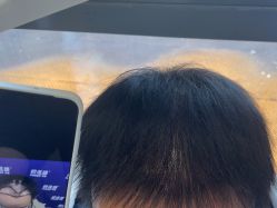 -碧莲盛·不剃发植发