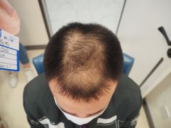 -大麦微针植发丨全国连锁