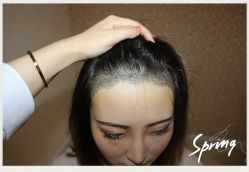 点击看大图 -大麦微针植发全国连锁