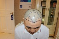 -大麦微针植发丨全国连锁