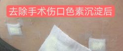 -净肤洗纹身