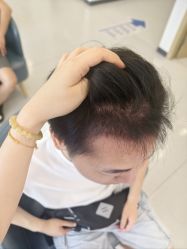 -大麦微针植发全国连锁