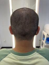 体验后-大麦微针植发全国连锁