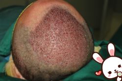 点击看大图 -大麦微针植发丨全国连锁