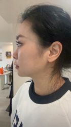 体验前-杭州美莱医疗美容医院