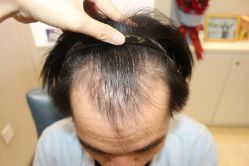 -大麦微针植发丨全国连锁