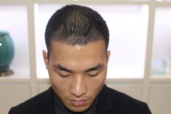 -大麦微针植发丨全国连锁