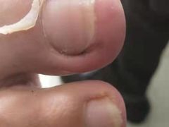 -祖传修脚甲沟炎灰指甲鸡眼