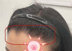 -大麦微针植发全国连锁