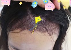 -大麦微针植发全国连锁