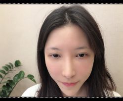 -大麦微针植发全国连锁