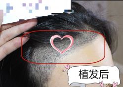 -大麦微针植发丨全国连锁