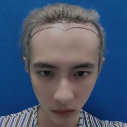 -碧莲盛·不剃发植发