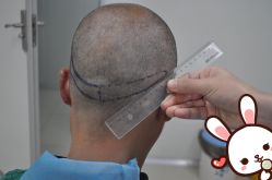 点击看大图 -大麦微针植发丨全国连锁