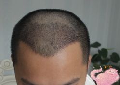 -大麦微针植发丨全国连锁