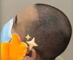 -大麦微针植发丨全国连锁