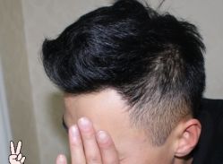 -大麦微针植发丨全国连锁